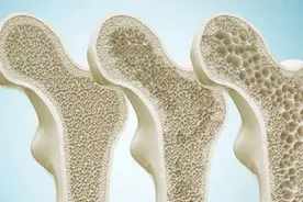 50岁后，这些“偷钙”食物要少吃，管住嘴，骨骼年轻，腿脚麻利图片