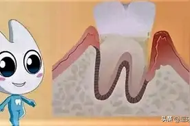 认识一下牙周病图片