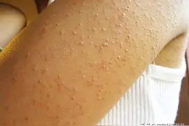 夏季不敢露胳膊露腿？鸡皮肤，我该拿你怎么办？图片