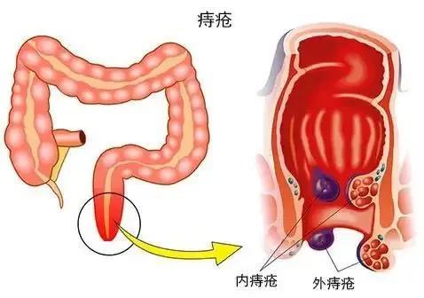 痔疮出血该如何处理？