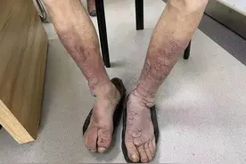 碘131治疗甲亢后成甲减，出现严重的并发症，如何避免并发症？图片