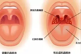 喝水像吞针？为啥你的扁桃体炎，来得那么勤？图片
