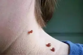 脖子和腋下长的“小肉粒”是什么？会影响健康吗？早知道早治疗图片