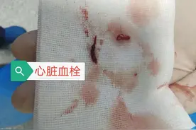 血栓到底长啥样？看这位50岁患者，心脏大血栓堵塞！心脏血栓抽出图片