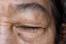 眼部年轻化，去眼袋手术的内切和外切如何选择？图片
