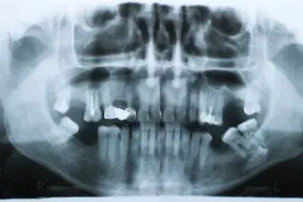 看牙拍片对身体危害多大？拍几次会致癌？影像室医师告诉你实话图片