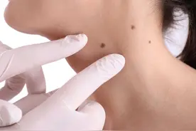 再三提醒：长在3个部位的痣，或与癌症“密切相关”，尽早处理图片
