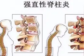 侧卧睡觉十几年，祸根竟是强直性脊柱炎？术后终“抬起胸膛做人”图片