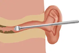 为什么有人的耳屎会“流油”？干耳朵和油耳朵，到底哪种更健康？图片