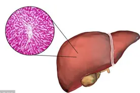 肝囊肿每年增大，原因其实很简单，找准病因，消除囊肿并不难图片
