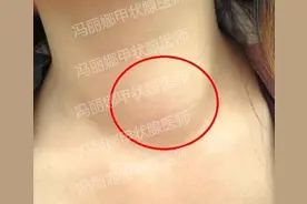 如果近期发现孩子脖子肿了，不要认为是孩子胖了，警惕甲状腺问题图片