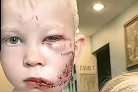 别怕，哥哥在，6岁男孩为救妹妹脸被狗咬得面目全非！图片