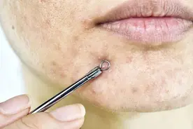 脸上频繁长痘，或与这4种因素有关，需了解，才能做好预防图片