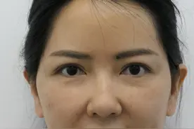 40岁中年女性为美奔赴北京，全脸整形90天后，颜值翻倍变“姐姐”图片
