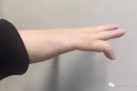 运动后手指伸不直？警惕锤状指图片