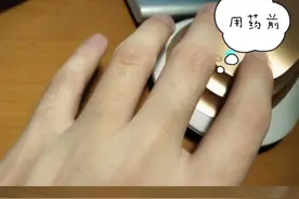 离大谱！我的男同事竟然用米诺地尔来长体毛！图片