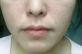 脸干的要命怎么办？脸严重缺水用什么补水最有效？（超有用）图片