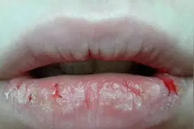 菠萝“咬人”事件图片