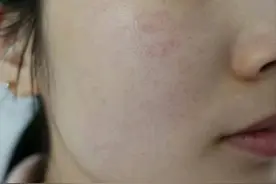 如何轻松应对红血丝？图片