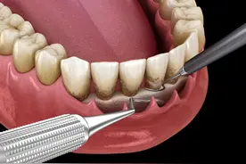 「牙周刮治」你知道为什么医生会建议你做牙周刮治吗？图片