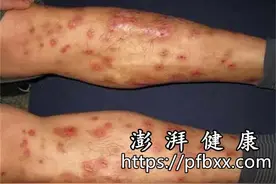 腿上长很多包包且很痒硬硬的凸起是怎么回事图片