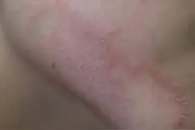 猫癣可以传染给人 人被猫传染的皮肤病怎么治疗图片