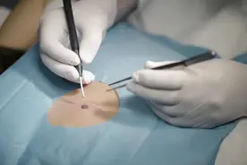 无论男女，身上长这 3 种痣多半要癌变，一定要留意！图片