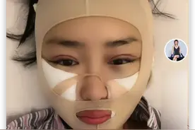 本山传媒娇娇自曝整容，晒术后照被指认不出，多次割眼皮肿胀明显图片