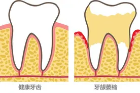 为什么会产生牙龈萎缩？图片