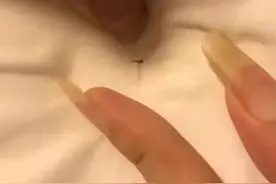 女子称民宿床上有针，其妹妹的手被扎破，“担心她感染病毒”，市监局：已接到投诉，正在处理中图片