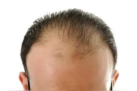 过来人亲测有效的两款防脱洗发水大公开！坚持使用，发量惊人！图片