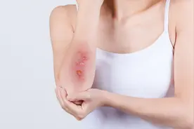 海曲泊帕，国产升血小板口服药图片