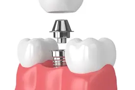 种植牙还有二期手术？二期手术是干什么，需要注意什么？图片