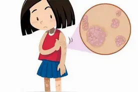 皮肤上起褐色斑块表面粗糙痒图片