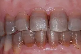 牙齿越变越黑，很可能是这几个问题引起的，建议都要重视！图片