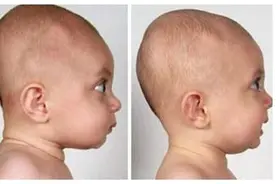 你还在给孩子睡扁头吗？扁头除了影响颜值，对智商有影响吗图片