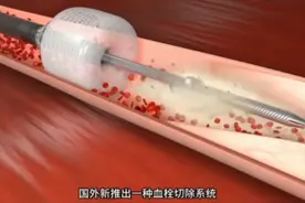 高科技抽血栓2分钟干干净净，到底是高科技，还是骗人把戏？图片