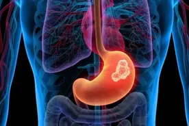 胃癌早期不痛不痒？医生：身体出现3个症状，可能暗示癌症来临图片