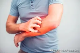 【世界过敏日】夏季皮肤过敏知多少图片