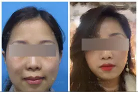 41岁姐姐的第一次医美经历：从忐忑到惊喜，只用了短短的一周图片