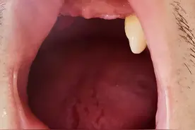 年纪轻轻牙齿脱落仅剩一颗！38岁男子糖尿病多年不在意，并发严重牙周病图片