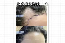 发际线和额角一起调整，是什么样子的？图片