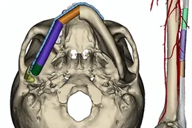 切除口腔肿瘤，女子“需”毁容！数字化导航、3D打印……手术团队为她重塑颜面图片