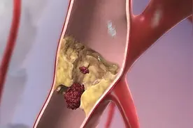 脑供血不足怎么办？这些检查方法和预防措施你一定要知道！图片