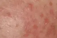 消风散治愈顽固湿疹图片