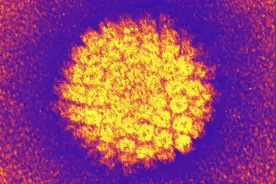 HPV感染，湿热下注！一张方子，清热利湿祛毒，三个月转阴图片