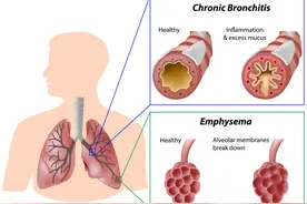 慢阻肺常用2药，宣肺化痰止咳平喘，改善呼吸困难，消除反复发作图片