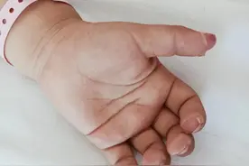 幼儿持续发烧眼红手足肿｜遇到高明医生：川崎病，要住院图片