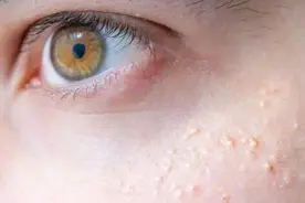 脂肪粒问题，这些注意事项帮你解决图片