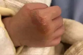 孩子被热油烫伤，妈妈30分钟三步处理，医生叔叔竖起大拇指图片